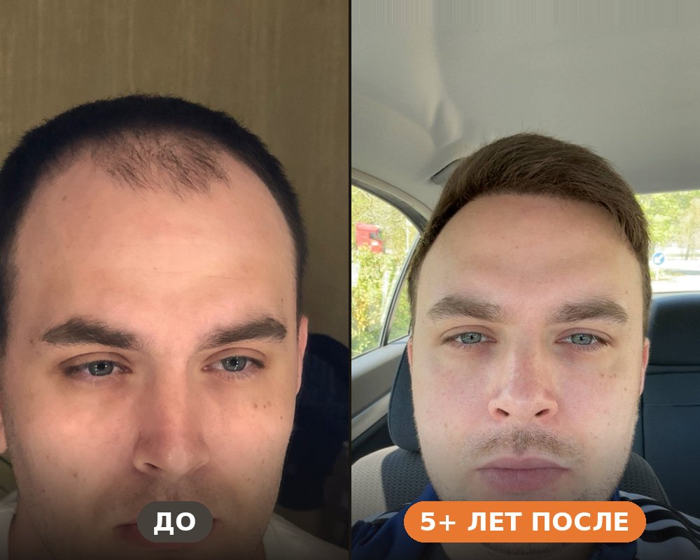 Пересадка волос FUE в Стамбуле — до и спустя 5+ лет