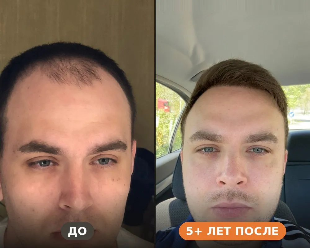Пересадка волос FUE в Стамбуле — до и спустя 5+ лет
