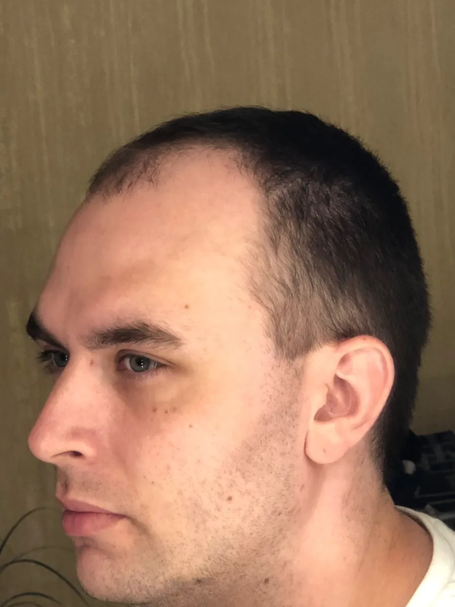 Denys before his hair transplant, side view
