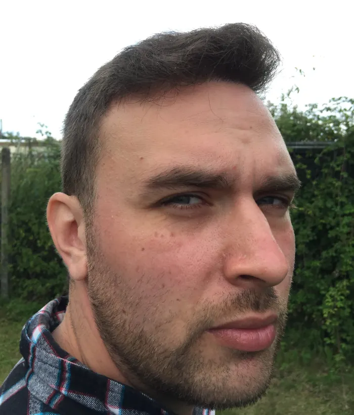 Day 380 after FUE hair transplant, front view