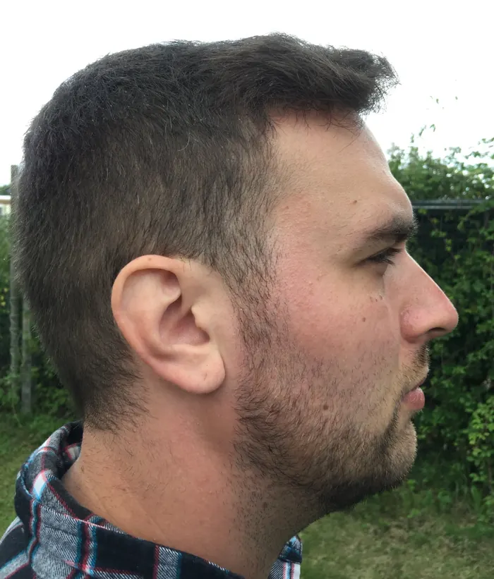 Day 380 after FUE hair transplant, side view