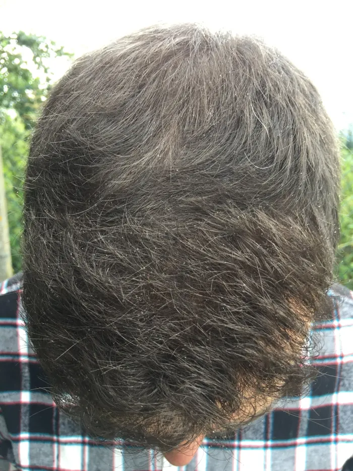Day 380 after FUE hair transplant, top view