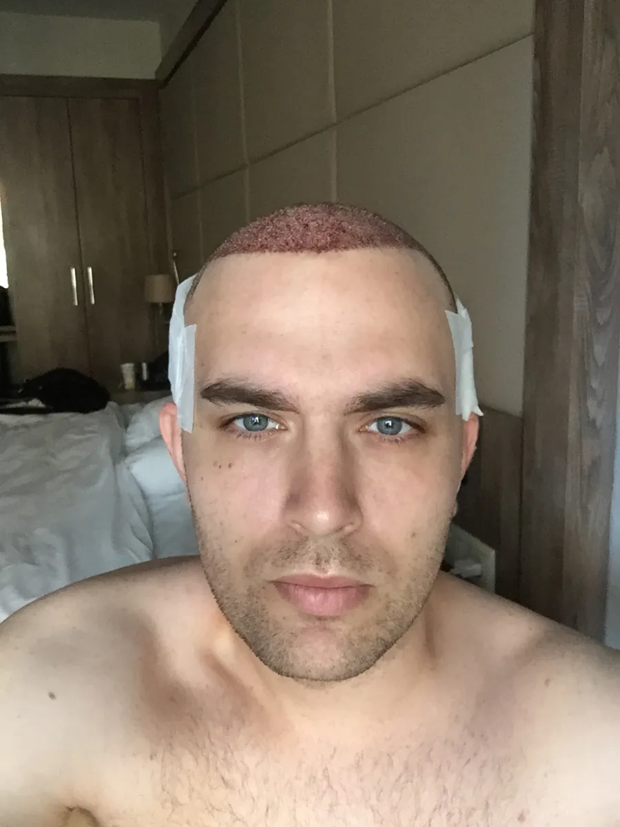 Day 2 after FUE hair transplant, bandage removed