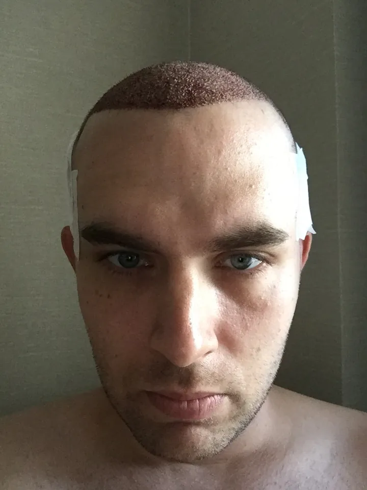 After FUE hair transplant — bandage on the evening after surgery