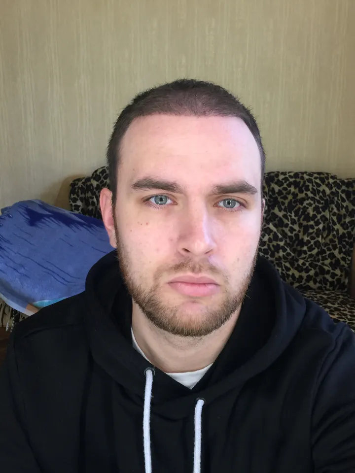 4 месяца после пересадки волос FUE — вид спереди