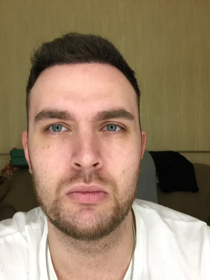 6 месяцев после пересадки волос FUE — результат, вид спереди