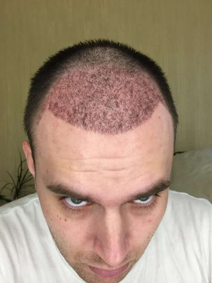 1 месяц после пересадки волос FUE — вид спереди