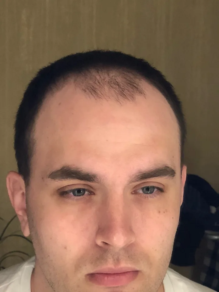 Before — front