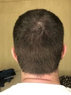 1 year — donor